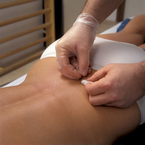 Dry Needling in Cochrane by Mission Health Physiotherapy & Massage